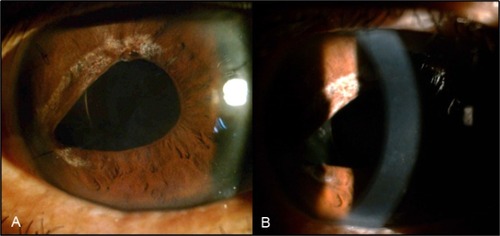 Figure 3 After cataract surgery, the corneal bloodstaining seemed to nearly disappear in the center 10 months after AC irrigation with sparse anterior stromal traces from anterior view (A) and oblique view (B).