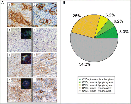 Figure 2. Immunohistochemical and FISH analysis of PD-L1 in 48 cases of the high-grade STS cohort. (A) Immunhistochemical staining and FISH for PD-L1. (1) PD-L1 staining of lung adenocarcinoma serving as a positive control. Note the membranous and cytoplasmic staining of tumor cells as well as membranous staining of inflammatory cells. (2) PD-L1 staining of tonsillar tissue illustrates membranous staining of lymphocytes and antigen presenting cells. PD-L1 CNG and protein expression in STS cases without (3) and with (5, and 7) CNG as detected by aCGH. Higher magnifications are presented aside (4, 6, and 8). A case of UPS (3, and 4) with balanced PD-L1 copy number on aCGH analysis showing absent PD-L1 protein expression. Representative pictures showing membranous staining of PD-L1 in a sample of DDLS (5, and 6) and UPS (7, and 8). Insets illustrates results of FISH analyses demonstrating PD-L1 copy number status (PD-L1/CEN9 dual-color FISH probe; green, PD-L1; red, CEN9; blue, DNA). Scale bars, 50 µm. (B) Pie chart showing the association of PD-L1 CNG, PD-L1 staining of tumors cells and PD-L1 staining of immune cells.