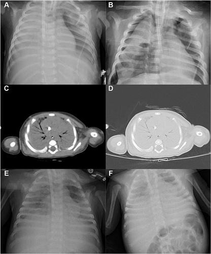 Figure 2 Imaging data of lungs. (A) on the 1st day of admission, CR showed exudation in both lungs and large effusion in the right pleural cavity. (B) CR indicated a large amount of diffuse patchy exudation in both lung fields on the 4th day. (C and D) Chest CT scans showed dense shadow and consolidation were diffused in both lungs on the 12th day. (E and F) on the day before discharge day, CR showed exudation and consolidation still existed in large areas of the lungs.