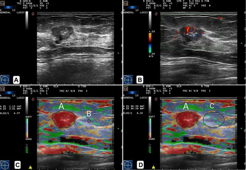 Figure 2 Invasive ductal carcinoma grade II in a 50-year-old woman. (A) Greyscale US image showed an irregular hypoechoic mass. (B) Color Doppler showed the blood flow was abundant in the mass. (C and D). Elastographic image showed the lesion scored 5, and ROI (A) was drawn along the margin of the lesion, and its strain was recorded. The ROI (B) and ROI (C) were selected at the normal glandular tissue, which reflected the strain of glandular tissue. ROI (B) was small (≤3.1mm2) and ROI (C) was as large as ROI (A). SR1 was 4.77 (C), and SR2 was 6.32 (D).