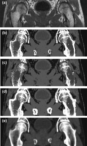 Figure 2. Example coronal views of pseudo-CT images with variable-sized bone segments. Pseudo-CT image without additional error in bone segment is shown in (b), and images with additional − 3 mm and + 3 mm bone segmentation errors are illustrated in (c) and (d), respectively. The original MR image and the corresponding CT image are presented in (a) and (e), respectively.