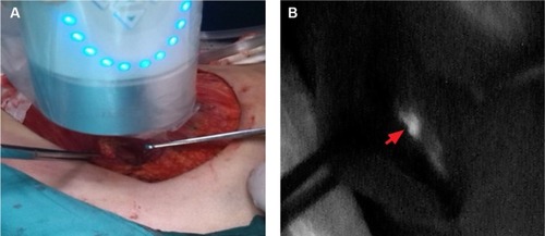 Figure 2 Intraoperatively IM-SLNB via intercostal space.