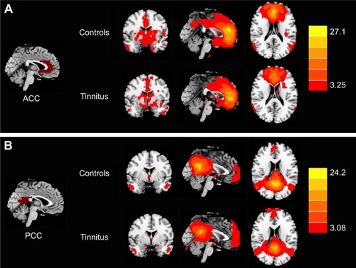 Figure 2 Significant FC patterns from the ROIs of the (A) ACC and (B) PCC in whole brain by using one-sample t-test in both chronic tinnitus patients and healthy controls.