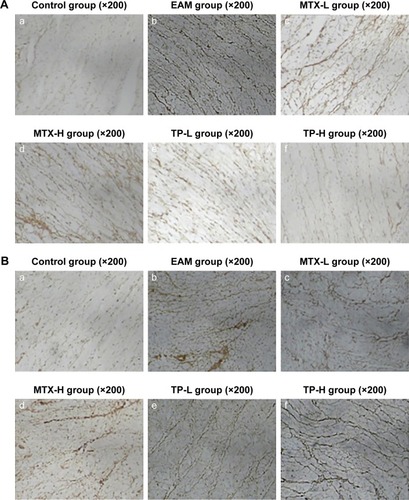 Figure 6 (A) Collagen type I of the myocardium in rats for each group. (a) In the control group, there were only a few brown collagen fibers (type I) around the myocardial cells. (b) In the EAM group, the type I collagen fibers were of obvious hyperplasia. (c–f) The type I collagen fibers decreased significantly. (B) Collagen type III of the myocardium in rats for each group. (a) In the control group, there were only a few brown collagen fibers (type III) around the myocardial cells. (b) In the EAM group, the type III collagen fibers were of obvious hyperplasia. (c, d) The type III collagen fibers decreased to some extent. (e, f) The type III collagen fibers were hyperplasic.Abbreviations: EAM, autoimmune myocarditis; H, high dose; L, low dose; MTX, methotrexate; TP, triptolide.