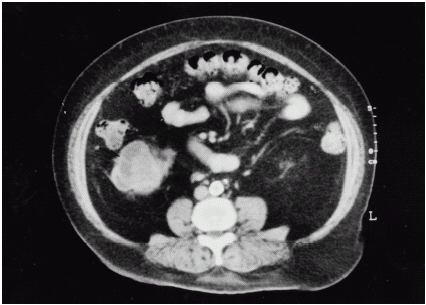 Figure 1. CT scan showing a low-attenuation mass with an irregular wall (arrow) in the right kidney's lower pole.