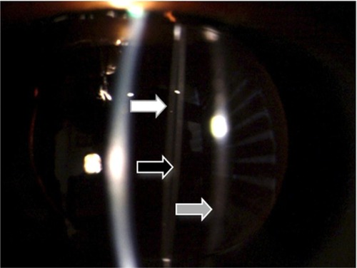 Figure 1 Anterior segment photography of the right eye.