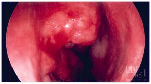 Figure 2. Preoperative endoscopic view of right-sided nasal mass.