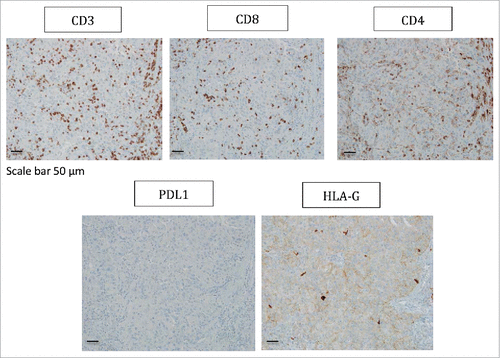 Figure 3. Representative staining obtained by immunohistochemistry analysis for CD3, CD8, CD4, PDL1 and HLA-G expression in tumor biopsy from patient #8 are shown. Formalin-fixed tumor tissue sections from the tumoral thrombus of the renal vein were stained with antibody directed either against CD3, CD8, CD4, PDL1 or HLA-G marker. Brown labeling indicates marker positivity. Scale bar is indicated.