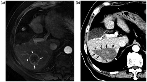 Figure 2. A 73-year-old male patient undergoing percutaneous microwave ablation for recurrent intrahepatic cholangiocarcinoma eight months after partial hepatectomy. (a) Enhanced MR images eight months after partial hepatectomy show a 3.5 cm lesion with peripheral enhancement (arrows) during arterial phase located in right posterior lobe; (b). Enhanced CT obtained one month after microwave ablation show a non-enhanced area with a clear margin in corresponding site (arrows), demonstrating complete ablation.