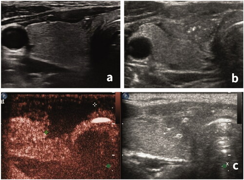 Figure 2. Evaluation of ablation completeness by contrast-enhanced ultrasonography. (a) Before the ablation, a hypoechoic nodule, approximately 3 × 3 × 2 mm in size, was visible in the isthmus of the right thyroid. (b) After the extended ablation, the original nodule was replaced by a patchy and irregularly shaped hypoechoic area. (c) Contrast-enhanced ultrasonography showed no enhancement (complete necrosis) in the ablation area with a range of approximately 18 × 16 × 10 mm.