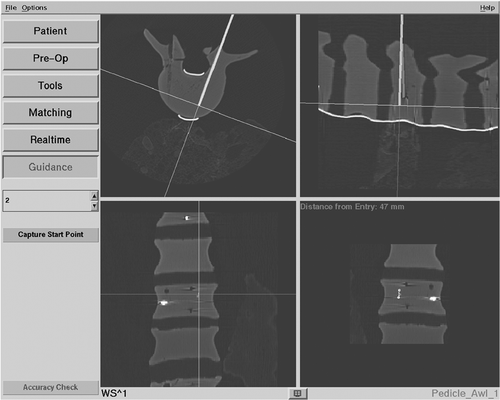 Figure 5. Monitor screenshot of the measurements for pedicle accuracy. The trajectory (dark grey) was planned into the prepared holes and the navigated pedicle awl (light grey) was placed into the vertebra. On the screenshot, the deviation with respect to the angle and the deviation of the entrance point were measured.