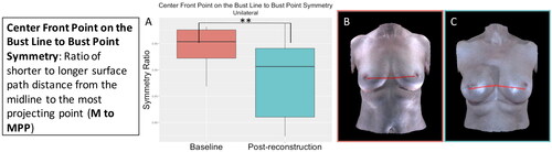 Figure 9. The centre front point on the bust line to bust point symmetry significantly decreased (became more asymmetrical) for the participants who underwent unilateral implant-based reconstruction (p = 0.01). (A) Boxplot of symmetry at baseline and post-reconstruction (median and interquartile range). (B) The centre front point on the bust line to bust point measurement on an exemplar patient. (C) The centre front point on the bust line to bust point measurement on the same patient post-reconstruction.