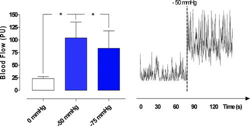 Figure 2.  Microvascular blood flow measured at a depth at 1–2 mm in the myocardium (epicardium) in seven pigs, after 40 minutes of occlusion of the left anterior descending artery and hypothermia at 31°C. Recordings were made before and after the application of topical negative pressures of −50 mmHg and −75 mmHg. The results are shown as mean values±SEM, in the left panel. A level of *p < 0.05 was considered statistically significant. The right panel shows a representative example of microvascular blood flow changes before and after application of −50 mmHg. Note the immediate increase in microvascular blood flow response when the negative pressure is applied.