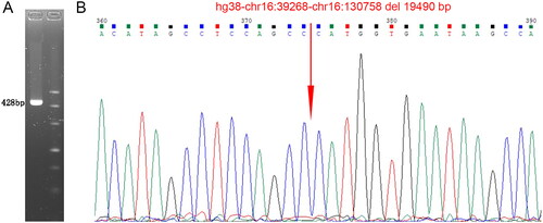 Figure 3. Confirmation of the deletion (αα)FJ identified in the family. (A) Amplification of deletion (αα)FJ by Gap-PCR. (B) Sanger sequencing of the Gap-PCR product, indicating the breakpoints of the deletion.