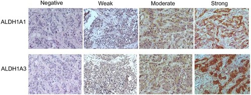 Figure 1 Immunohistochemical analysis of ALDH1A1 and ALDH1A3 in breast-cancer specimens. Representative images are shown of negative, weak, moderate, and strong immunolabeling.