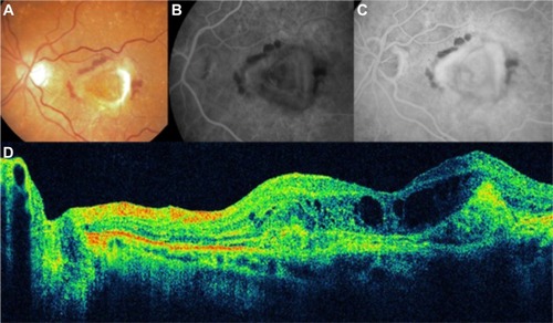 Figure 15 Choroidal neovascularization in age-related macular degeneration.