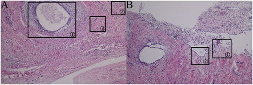 Figure 5. (a)Brown lesion (HE × 400). (b)Brown lesion (HE × 100).Brown lesion: The ectopic lesion was located in the subperitoneum, and most of the glandular structures were medium in size, with dilated cavities and abundant stromal cell aggregation around the gland, as indicated in (a) marker ①; microvessels were occasionally visible around the lesion, as indicated in (a) marker ②, with abundant smooth muscle tissue distributed around the lesion, as indicated in (a) marker ③, and destroyed peritoneal mesothelial tissue structure, as indicated in (b) marker ①; and interrupted peritoneal mesothelial tissue structure was visible, as indicated in (b) marker ②.