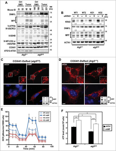 Figure 4. Impaired mitochondrial dynamics in autophagy-compromised tumor cells. (A) Increased abundance of mitochondrial fission-related proteins, DNM1L and MFF, in KRAS-transformed tumors. Equal amounts of total tissue lysates prepared from control and tumor-induced mice (d 24) of both genotypes were subjected to western blot analyses as indicated. Levels of 5 oxidative phosphorylation enzyme complexes subunits including NDUFB8 (complex I), SDHB (complex II), UQCRC2 (complex III), MT-CO2 (complex IV) and ATP5A (complex V) were detected with total OXPOHS rodent WB antibody cocktail. Mitochondrial complex IV is shown as a loading control. A representative western blot of 2 mice per group is shown. Relative abundance of each protein is calculated by designating the level in control mouse (ID 51) as 1 after normalization with COX4I1 and shown in italics. Multiple bands in MFF western blot represent splice variants of MFFCitation58. (B) Knockdown of KRAS decreases MFF and DNM1L levels in KRASGCitation12V;atg5∆/∆ cells. Primary tumor cells were transfected with siRNA against human KRAS at 48 h prior to analyses. Relative fold change (siKRAS over Control) of each sample is calculated by designating the densitometry tracing value in the control as 1 after normalization with ACTA1, as shown in italics. (C and D) Knockdown of MFF reverts the fragmented mitochondrial phenotype notably in KRASGCitation12V;atg5∆/∆ (C) compared to KRASGCitation12V;Atg5+/+ (D) cells. Knockdown of MFF is shown by western blot analysis (upper panel, lower-right inset) with ACTA1 serving as a loading control (lower panel, lower-right inset). Multiple bands of MFF are likely due to alternative splicing. Scale bar: 10 µm. (E) Oxygen consumption rate (OCR) was measured in control (shCtrl) and Mff-KD (shMff) KRASGCitation12V;Atg5+/+ (WT) and KRASGCitation12V;atg5∆/∆ (KO) cells. Data are shown as the mean ± S.D.; n = 3. (F) Levels of ATP were measured in control and Mff-KD KRASGCitation12V;Atg5+/+ and KRASGCitation12V;atg5∆/∆ cells. The ATP levels were normalized to cell number. Data are shown as mean ± S.D.; n = 3. *: p < 0.05; **: p < 0.01; ***: p < 0.001 (Student t test, 2-tailed, unpaired)