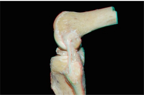 Figure 4 Lateral view of the posterolateral compartment of the flexed knee: lateral collateral ligament (1), popliteus tendon (2), popliteofibular ligament (3), and lateral meniscus (4).