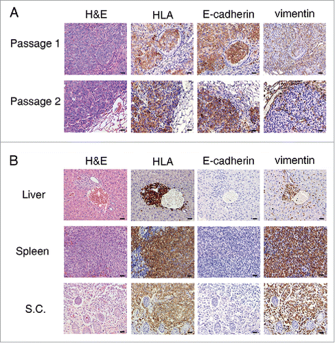 Figure 1. Generation and molecular characterization of patient-derived xenograft (PDX) models of non-small-cell lung cancer. (A) Hematoxylin and eosin (H&E) staining and immunohistochemistry detection of human leukocyte antigen (HLA), E-cadherin and vimentin in tumor sections from both the first and second passages of PDX mice for patient P2 (see from Fig. 2). Although HLA+ cells from PDX mice also expressed E-cadherin, cells from both passages were negative for vimentin. (B) H&E staining and immunohistochemistry detection of HLA, E-cadherin and vimentin in sections from liver, spleen and subcutaneous (s.c.) tissue. All sections were from a single mouse among the third passage of PDX mice for patient P1 (see from Fig. 2). Scale bar = 20 μm.