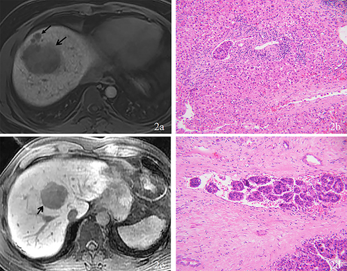 Figure 2 Representative MRI features associated with histopathological findings. HBP images (a) for a 29-year-old male patient showing peritumoral HBP hypointensity (arrow) and satellite nodule (arrowhead). Hepatocellular carcinoma with MVI-positive was confirmed by histopathology (b). HBP images (c) for a 41-year-old male patient showing a radiological capsule (arrow) without peritumoral HBP hypointensity. Hepatocellular carcinoma with MVI-positive was confirmed by histopathology (d).