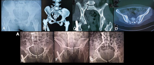 Figure 3. A female patient of zone II sacral fracture fixed with S2AI screw was presented. (A) Preoperative anteroposterior X-ray of pelvis. (B) Preoperative three-dimensional reconstruction. (C, D) Preoperative CT scans. (E-G) Postoperative anteroposterior, inlet, outlet X-ray of the pelvis.