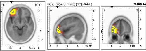 Figure 2 Voxel-wise statistical nonparametric map of sLORETA images in all patients (N=20) compared to healthy controls at the 0.05 significance level after correction for multiple comparisons.