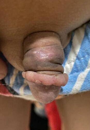 Figure 3 The penile wound healed 4 months after circumcision.