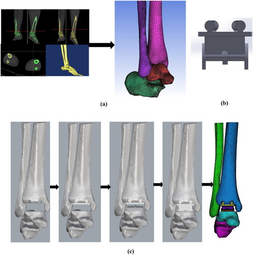 Figure 1. (a) Development of 3D Model of all the bones from CT scan data, (b) CAD model of the ankle prosthesis, (c) Virtual operation, implant positioning of the prosthetic ankle joint.