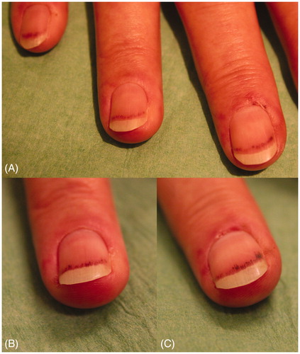 Figure 2. (A) Subungual petechial hemorrhages after two weeks. (B and C) After four weeks.