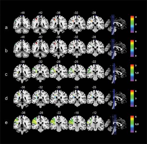 Figure 4. Colorized multi-slice maps of left hemispheric lesions at T1 and associated performance on the overall aphasia severity score (A) and subtests at T3. A: Aphasia severity, B: Auditory comprehension, C: Repetition, D: Reading comprehension, E: Reading out loud at T3 (n = 23). All maps include FDR-corrections with permutations, p < .05. Warmer areas (red) indicate a greater lesion overlap than colder areas (purple/blue). Color bars indicate Z scores