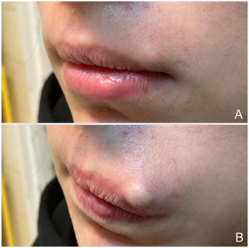 Figure 1. Preoperative pictures show a subcutaneous mass on the left side of the upper lip. (A) Appearance of the swelling at rest, and when the patient pushes it out with his tongue (B).