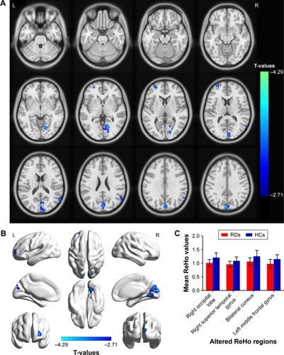 Figure 1 Spontaneous brain activity in the RDs and HCs. Significant activity differences were observed in the right occipital lobe, right superior temporal gyrus, bilateral cuneus and left middle frontal gyrus for multiple comparisons using Gaussian random field theory (z>2.3, P<0.01, cluster >40 voxels, AlphaSim corrected). (A) and (B) The mean values of altered ReHo values between the RD and HC groups (C).