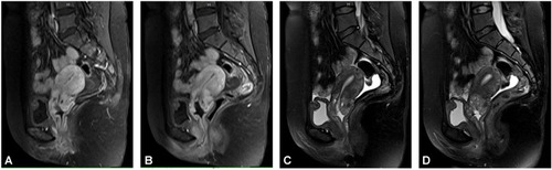 Figure 3 MRI image of the patient. The uterus presents posterior flexion, and the size of the uterus is 5.4cm × 6.0cm × 4.5cm. The endometrium is not thickened, without obvious abnormal signal. The cervix has a mass shadow, the size is about 3.6cm × 3.4cm × 4.4cm, T1WI showed iso-low signal (A and B), T2WI showed a little high signal (C and D), DWI showed high signal, uneven enhancement was seen after enhancement, and no obvious abnormal signal foci were seen around the uterus. There were no obvious abnormalities in bilateral ovaries and bilateral appendage areas. The bladder is well filled, the bladder wall is not thickened, and there is no obvious abnormal signal shadow on the bladder wall. There was no obvious abnormal signal shadow in the vagina, urethra and rectum, and there was a slight swollen lymph node shadow beside the right iliac blood vessel. A small amount of free fluid signal in recto-uterine pouch.