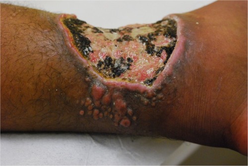 Figure 5 Ulcerated presentation with small fibrous plaques and nodules at its borders.