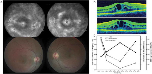 Figure 1. Cystoid macular edema at several time points during immune-monitoring. (a) Upper left and right: fluorescein angiography of the right and left eye of an patient with retinal dystrophy at presentation revealing extensive fluorescein leakage in the macular area. Lower left en right: fundoscopy color images of the right and left eye of the same patient at presentation. (b) Optical Coherence Tomography images of the macula of the right (upper image) and left (lower image) eye at presentation revealing CME. (c) Dynamics of foveal thickness (measured by OCT), the frequency of CD1c+ mDC cells in blood and their activation status (measured by expression of activation marker CD86) through time.CME: Cystoid Macular Edema; mDC: myeloid dendritic cell; MFI: mean fluorescence intensity; OCT: Optical Coherence Tomography.