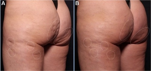 Figure 3 (A) Before and (B) after photos of Cellfina® treatment in a 50-year old woman (Courtesy of Dr Jeremy B Green).
