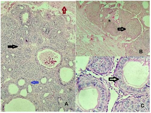 Figure 5 Histopathology of lesion. (A) Nodular proliferation of columnar or cuboidal cells in nests, whorls, and strands (black arrow). A few duct-like structures of varying sizes lined by columnar cells with an eosinophilic rim inside and basophilic inhomogeneous material seen within the lumen (blue arrow). Fibrous connective tissue is seen on the periphery (brown arrow). H&E staining, 100×. (B) Rosette-like structures of odontogenic epithelial cells. Trabecular patterns with numerous small ovoid and larger irregular basophilic calcifications (black arrow). H&E staining, 40×. (C) Duct-like spaces lined by a row of columnar epithelial cells (black arrow). H&E staining, 400×.