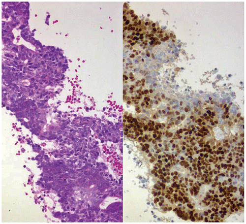 Figure 2: Endometrial Pipelle® histology.