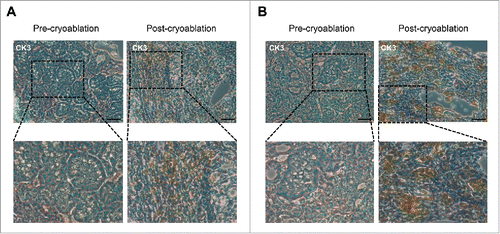 Figure 5. Drastic increase of CD8+ T cells and CD11c+ cells in post-cryoablation tissues. Representative immunohistochemistry results for CD8 (A) and CD11c (B) staining in tumor tissues of case CK3 before and after cryoablation. Magnification: 200 × for upper row, 400 × for lower row. Scale bars = 200 μm.