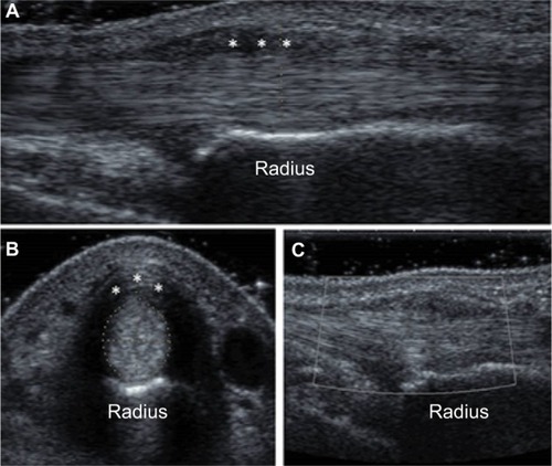 Figure 1 Ultrasound findings before methotrexate injection.