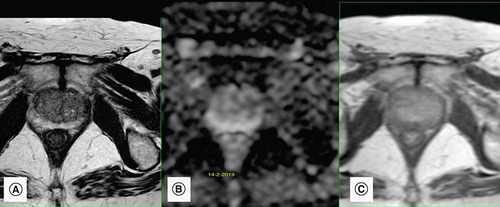 Figure 1. Multiparametric prostatic MRI before intravesical bacillus Calmette–Guérin therapy.(A) Axial T2-weighted image shows peripheral symmetrical hypointense linear lesions corresponding to sequelae of chronic prostatitis. (B) Apparent diffusion coefficient map of the diffusion-weighted image shows no corresponding diffusion restriction in peripheral zones. (C) Dynamic contrast enhancement shows only mild enhancement mainly in the left peripheral zone. These findings suggest sequelae of chronic prostatitis and a PI-RADS score of 2.