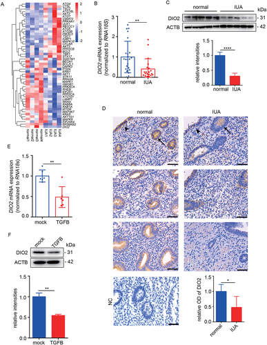 Figure 3. DIO2 is downregulated in endometria of IUA patients. (A) Heatmap showing autophagy-related genes in endometria of normal controls (n = 4) and IUA patients (n = 4). (B) The mRNA level of DIO2 in endometria of normal controls (n = 24) and IUA patients (n = 20) measured by qRT-PCR. (C) Top: The protein level of DIO2 in endometria of IUA patients (n = 5) compared to normal controls (n = 5) by Western blotting. Bottom: Relative band intensities analyzed by ImageJ. (D) Immunohistochemical staining of DIO2 in endometria of normal controls (n = 5) and IUA patients (n = 5). Scale bars: 50 μm. Arrow head: luminal epithelial cells; arrow: glandular epithelial cells. NC: negative control of DIO2 staining. (E) The mRNA level of DIO2 in EECs (n = 3) treated with TGFB for 48 h detected by qRT-PCR. (F) Top: The protein level of DIO2 in EECs (n = 3) treated with TGFB for 48 h detected by Western blotting. Bottom: Relative band intensities analyzed by ImageJ. Error bars, mean ± SEM. *P < 0.05, **P < 0.01, ****P < 0.0001.