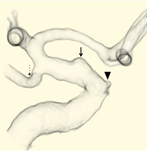 Figure 1 Preoperative computed-tomography angiography demonstrates a ruptured blood blister-like aneurysm (solid-line arrow) in the ophthalmic segment of the right internal carotid artery. The arrow head indicates ophthalmic artery, and the dotted-line arrow indicates the posterior communicating artery.