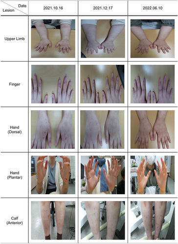 Figure 3 Clinical progress of atopic dermatitis.