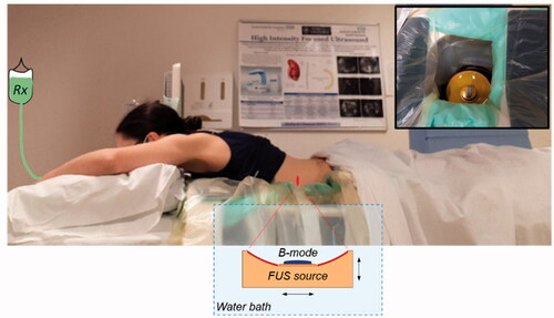 Figure 1. Illustration of the PanDox treatment concept. The patient lies prone over the JC200 water bath containing a FUS source fitted with a coaxial B-mode probe (inset photo). For induction of mild hyperthermia, the FUS source is continuously scanned under B-mode guidance to cover the prescribed treatment volume.