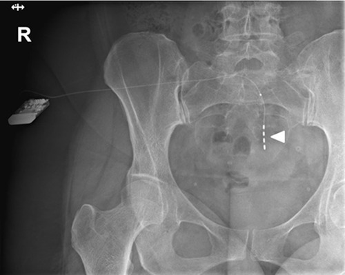 Figure 1 Anterior fluoroscopy of an implanted rechargeable SNM. The arrowhead points to the four electrodes.Abbreviaton: SNM, sacral neuromodulation.