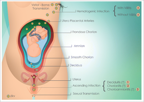 Figure 2. Schematic representation of the possible human transmission routes of ZIKV: vector-borne and sexual. Following the possible routes of maternal-fetal transmission of ZIKV with their respective infectious consequences:- hematogenous, or transplacental routes, causing or not causing villitis, and reaching the fetus through the fetal vessels.- ascending leading to deciduites, chorionitis, amnionitis and funisitis and reaching the amniotic fluid, thus reaching the fetus.