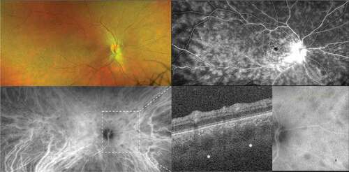 Figure 3. Birdshot retinochoroiditis. Ultra-widefield pseudocolor shows perivascular sheathing of retinal vessels; fluorescein angiography reveals diffuse retinal vasculitis and papillitis; indocyanine green angiography shows hypofluorescent foci of choroiditis, correspond to large hyporeflective areas within the choroid (asterisks) on optical coherence tomography (green line).