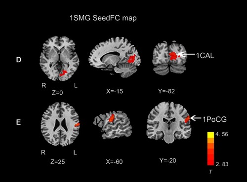 Figure 4 Functional connectivity differences between the two groups, lSMG selected as seed ROI (P<0.01, cluster-wise FDR corrected). Red-yellow spots, CSM>HC.